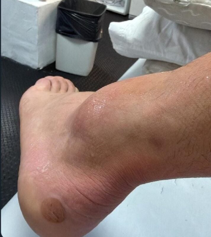 Costas Maravilla Martínez lesión